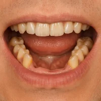 İmplant tedavisi öncesi