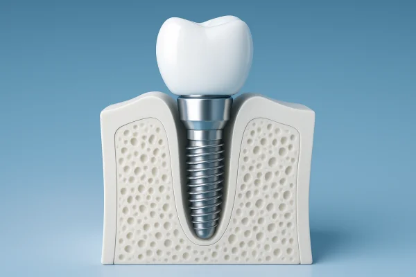 İmplant tedavisi